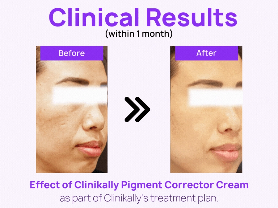 Clinikally The Ultimate NIA Serum   Pigment Corrector Cream