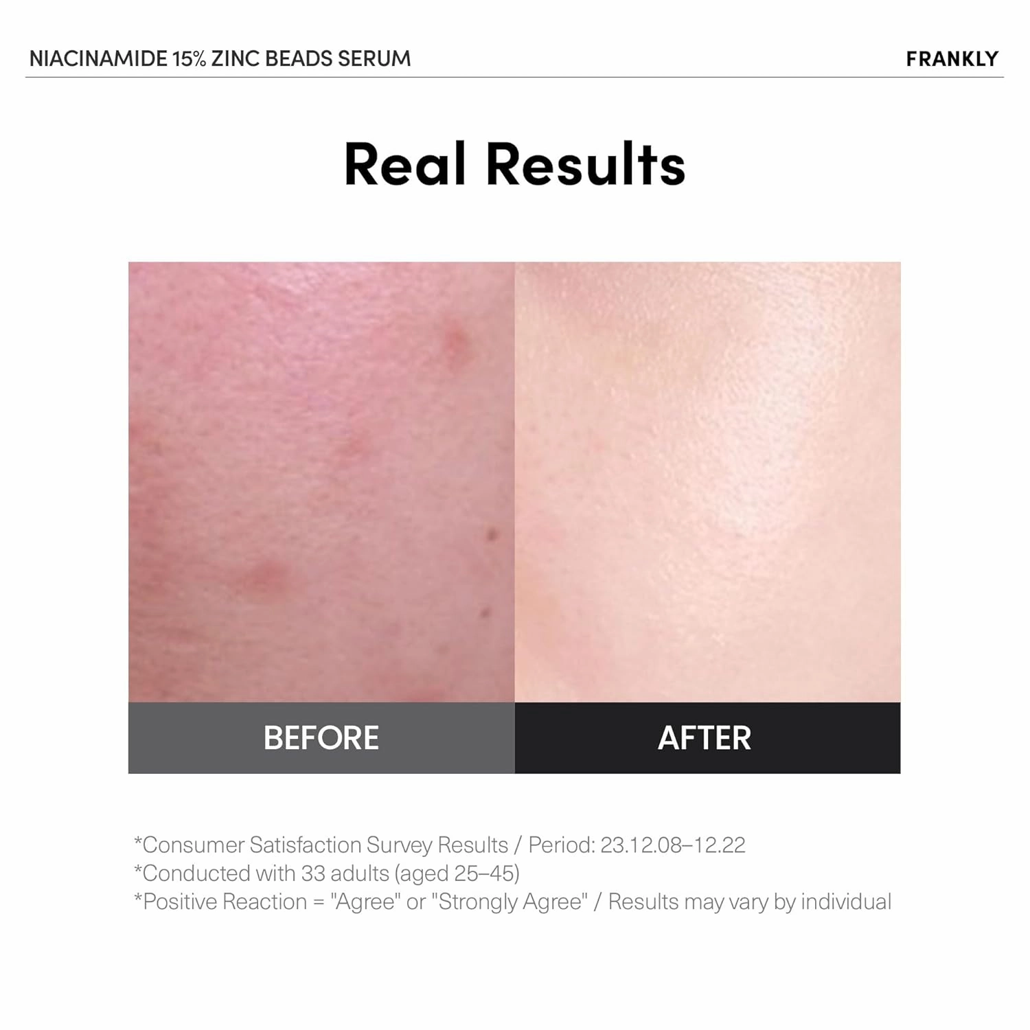 FRANKLY Niacinamide 15% & Zinc Beads Serum Jumbo: Acne & Dark Spots Care, Oil Control, Even Skin Texture & Glow | Vegan & Cruelty-Free | Non-Comedogenic All skin types Korean Skincare | 2.02 fl.oz