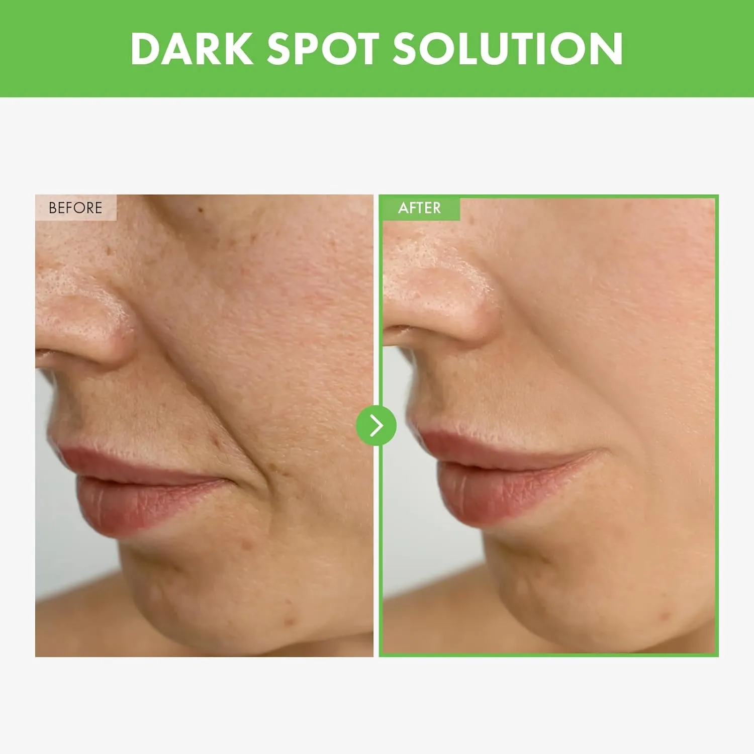 Kakadu Plum Blemish Cream, Dark Spot Remover for Face Cream, Kakadu Plum 600,000ppm, Niacinamide, Adenosine, Betaine, Dark Spot Corrector, Vitamin C, Korean Skin Care, 50g, 1.76 oz.